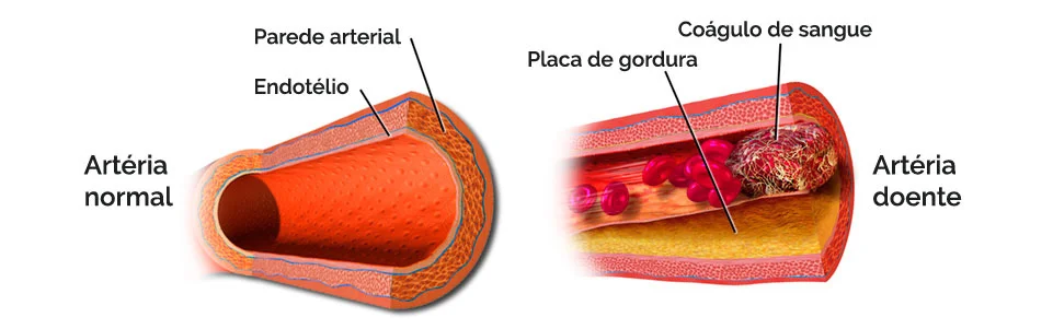 Qual a diferença entre úlcera venosa e úlcera arterial?