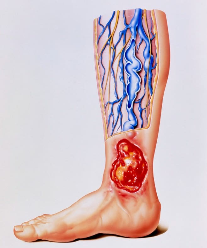 Qual a diferença entre úlcera venosa e úlcera arterial?