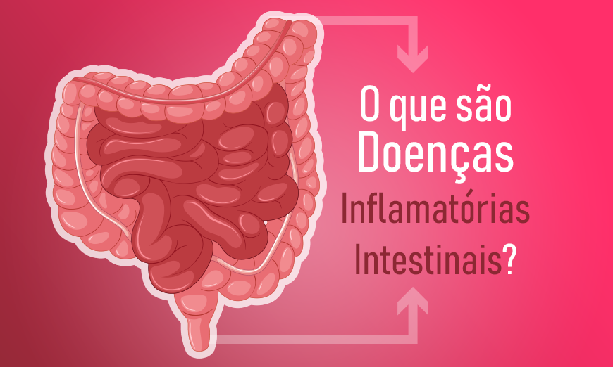 Pt O Que S O Doen As Inflamat Rias Intestinais Quais Os Sintomas