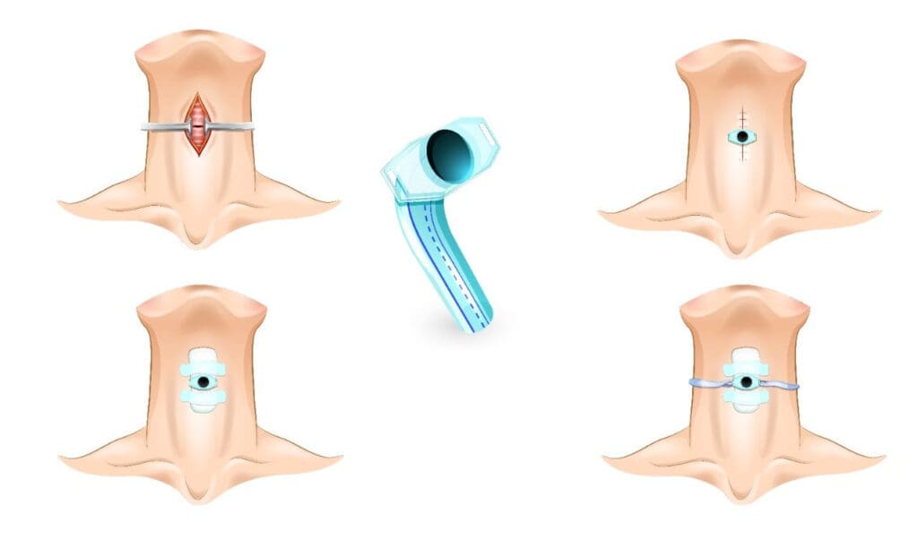 Traqueostomia: O Que É E Quando É Necessária