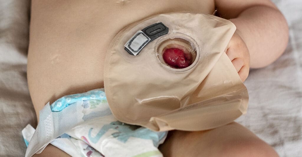 Bolsa de Colostomia Infantil e Bebês: Guia de Cuidados