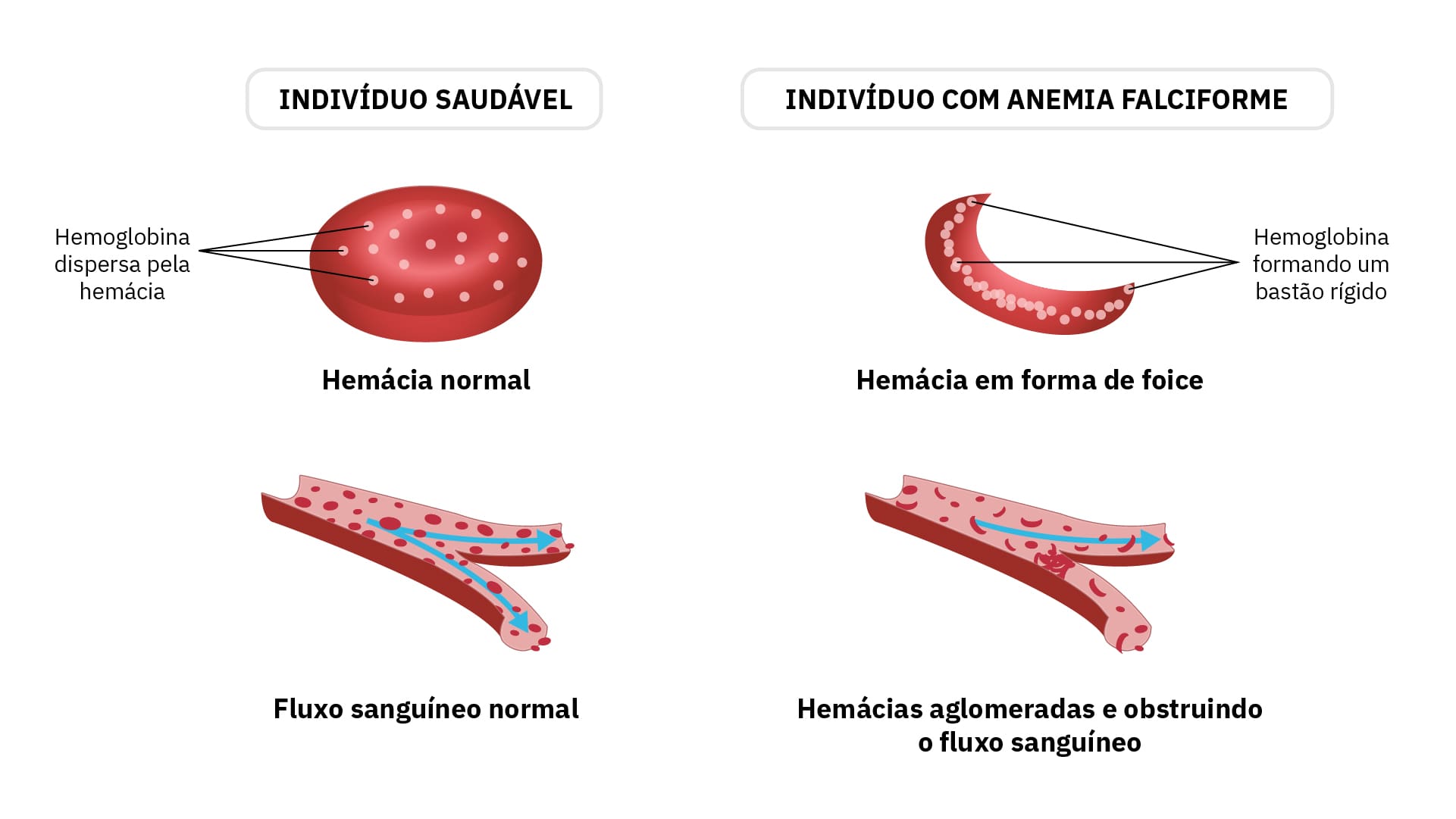 Anemia falciforme: O que é, tratamento e causas