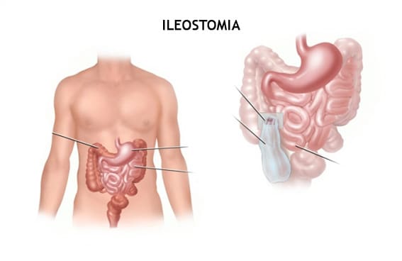 Ileostomia: O que é, como cuidar e cuidados