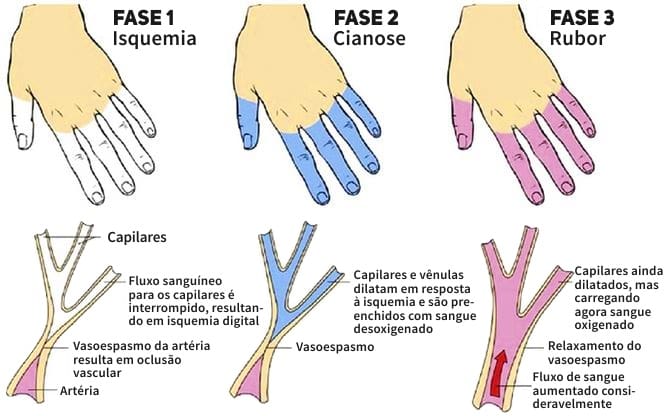 Queimadura de Frio: Como Evitar e Tratamentos