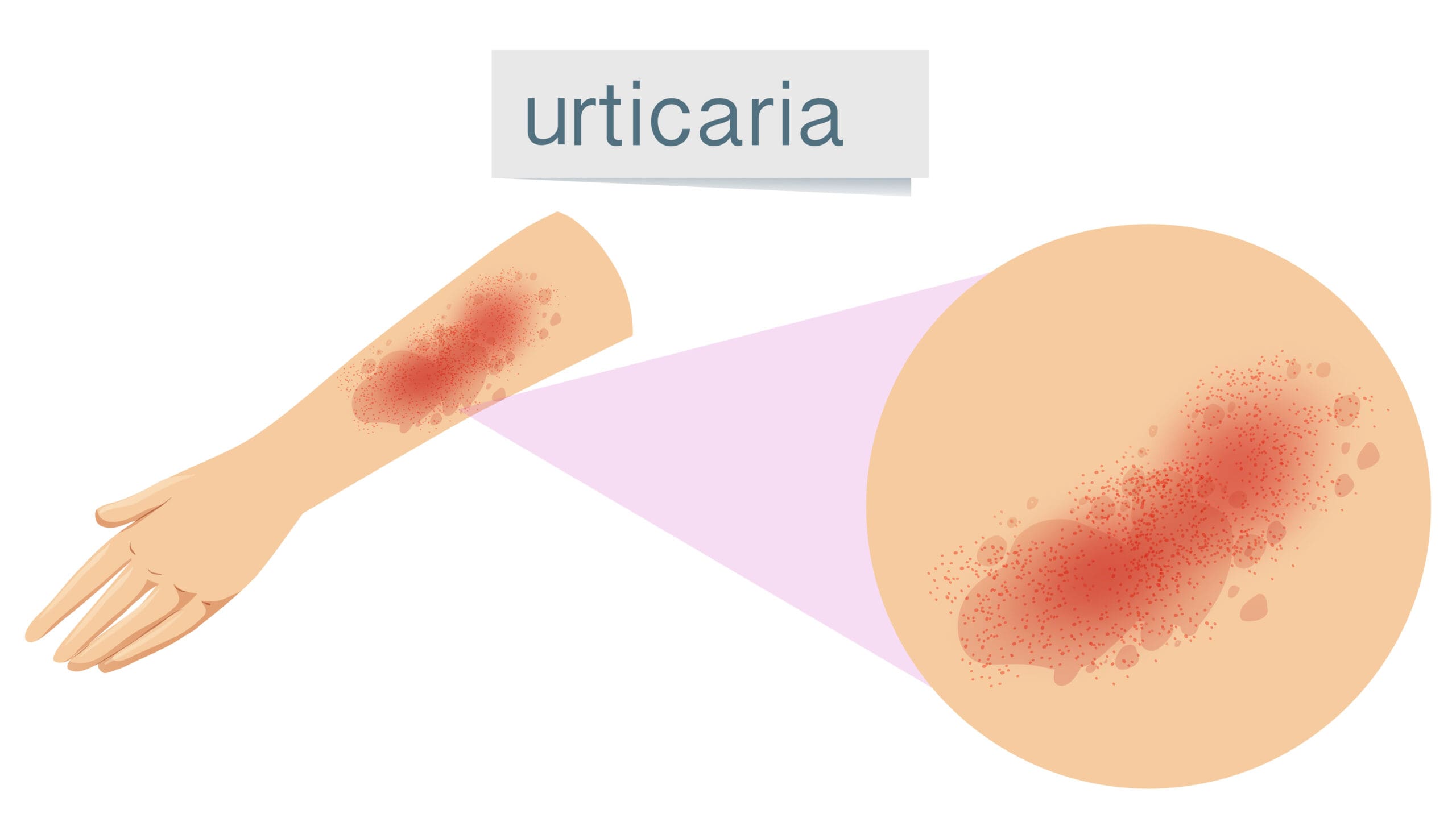 Urticária: Tipos, Sintomas e Tratamentos