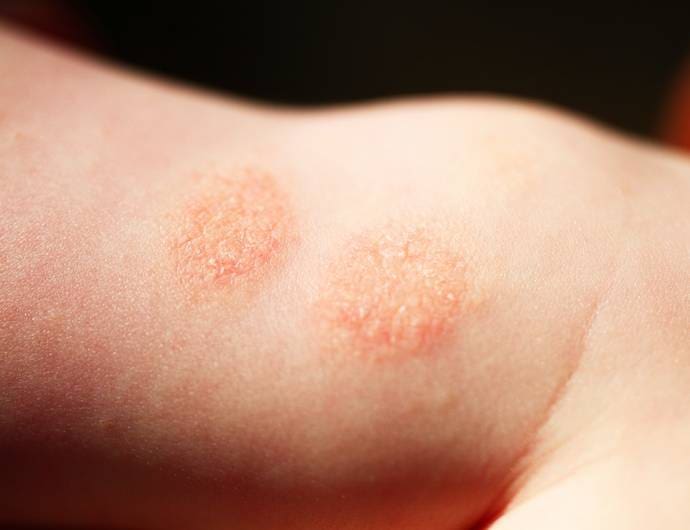 Dermatite Numular: Sintomas, Tratamentos e Prevenção