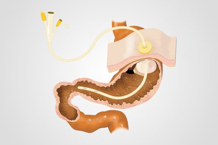 Gastrostomia: entenda o procedimento e quais os cuidados com a sonda