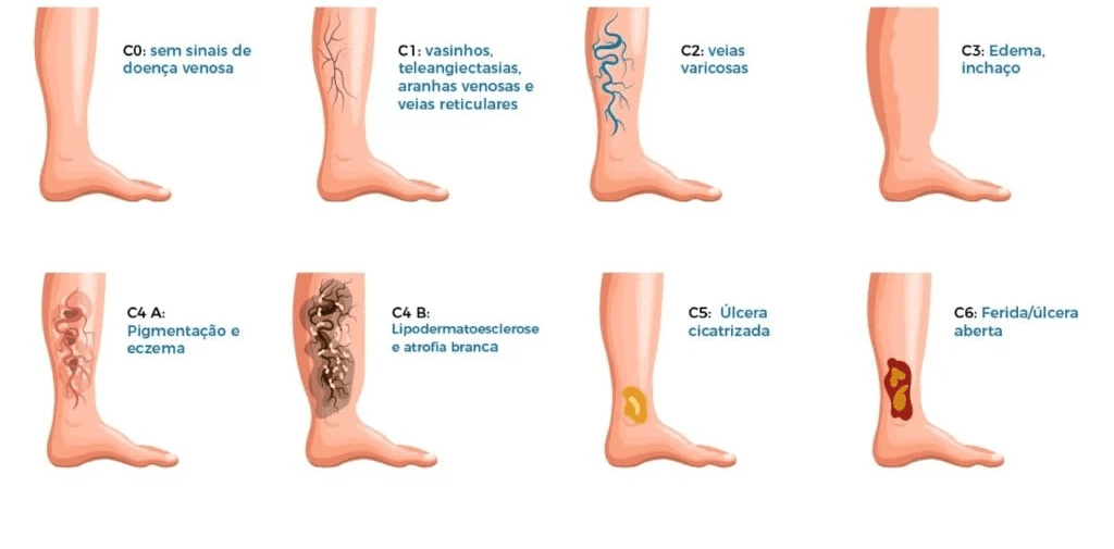 Como classificar/identificar a Insuficiência Venosa Crônica?