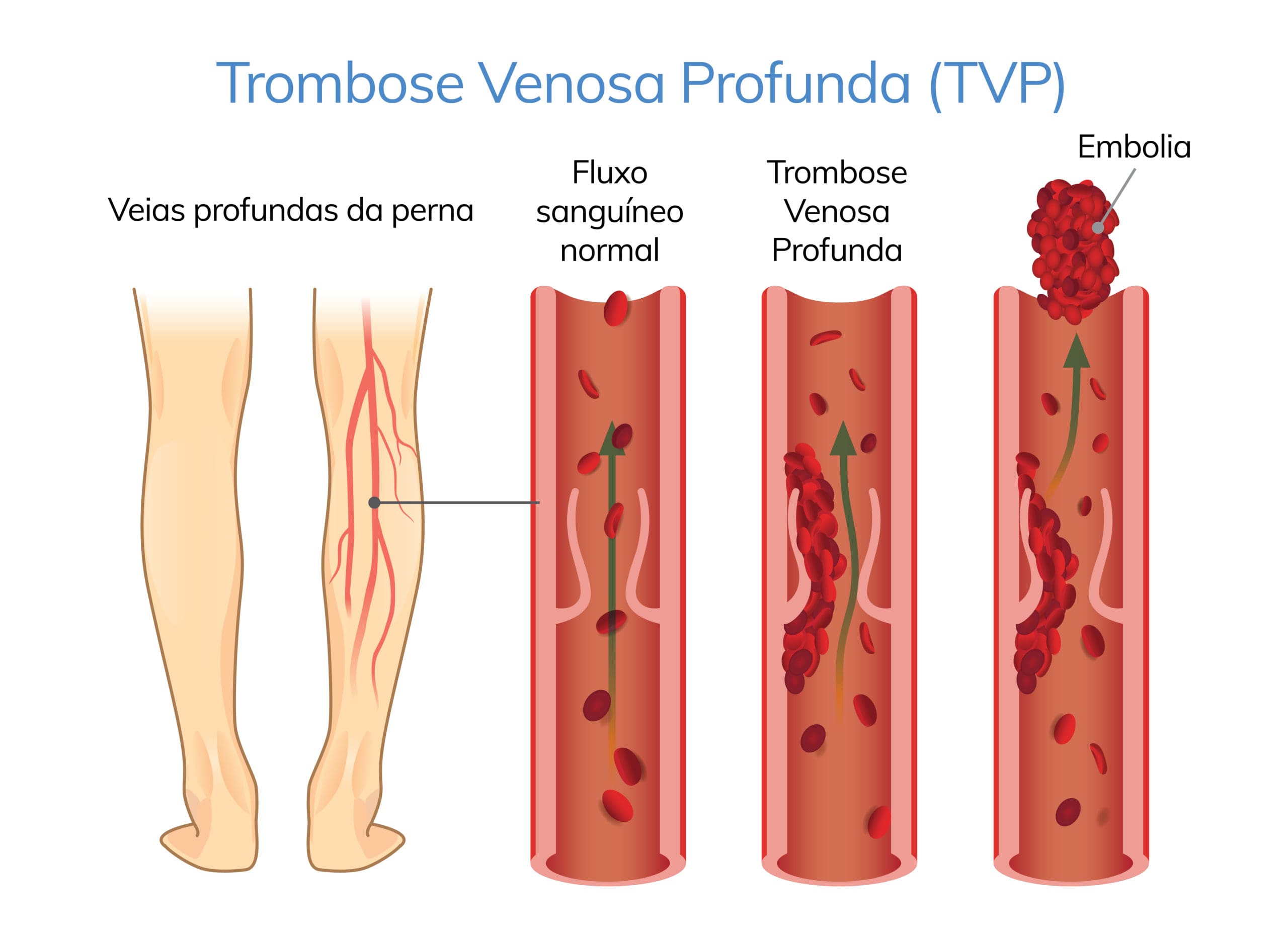 Trombose venosa profunda: sintomas, causas, prevenção e tratamentos