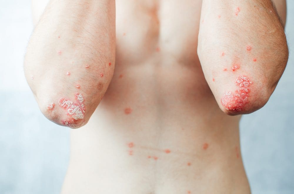 Aprenda a diferença entre psoríase, eczema e rosácea