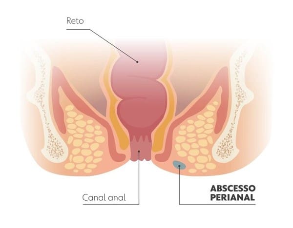 O Que é Abscesso e Como Tratar Infecções na Pele