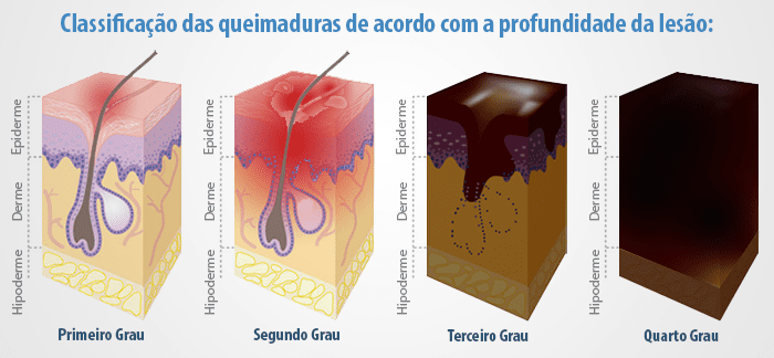 Queimadura de 4º grau: causas, primeiros socorros e tratamentos