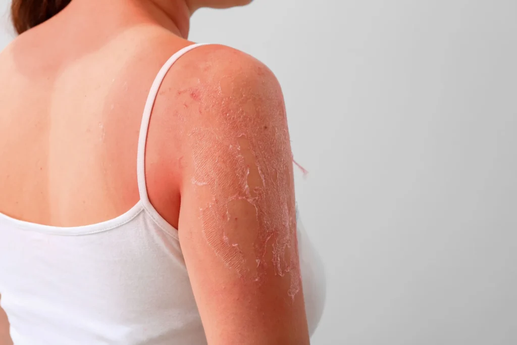 Aprenda a diferença entre psoríase, eczema e rosácea