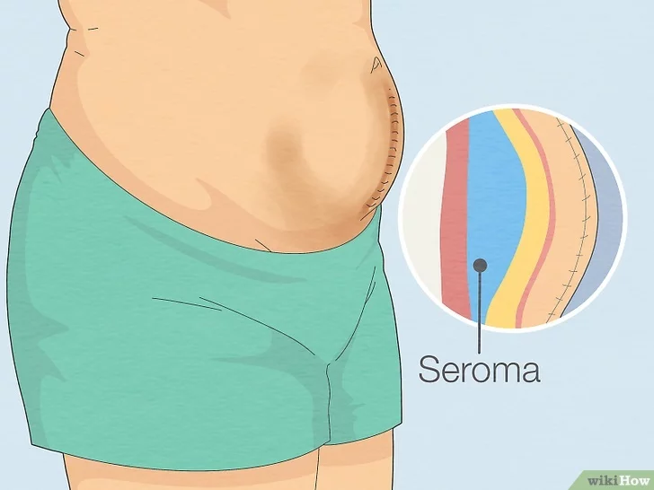 Seroma: Causas, Sintomas e Tratamentos Eficazes