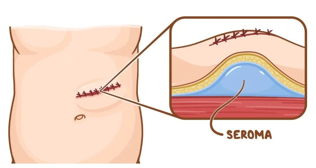 Seroma: Causas, Sintomas e Tratamentos Eficazes