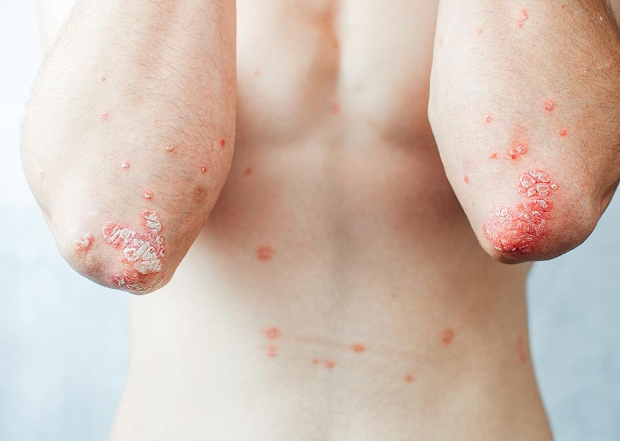 Aprenda a diferença entre psoríase, eczema e rosácea