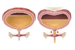 Bexiga Neurogênica: Causas, Sintomas e Tratamentos