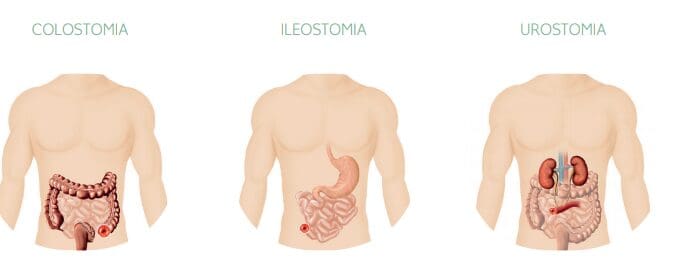 Dia Nacional dos Ostomizados: uma data para combater o preconceito e aumentar a conscientização