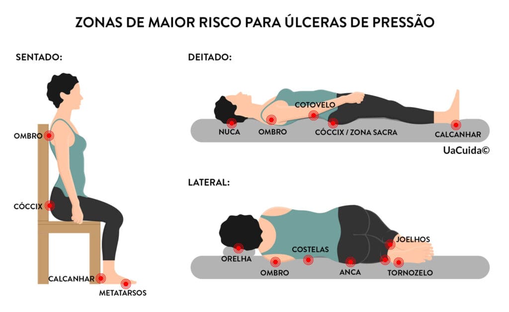 Úlceras por Pressão: Prevenção e Tratamento