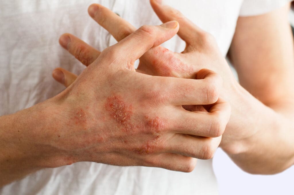 Eczema: Tipos, Sintomas e Como Tratar