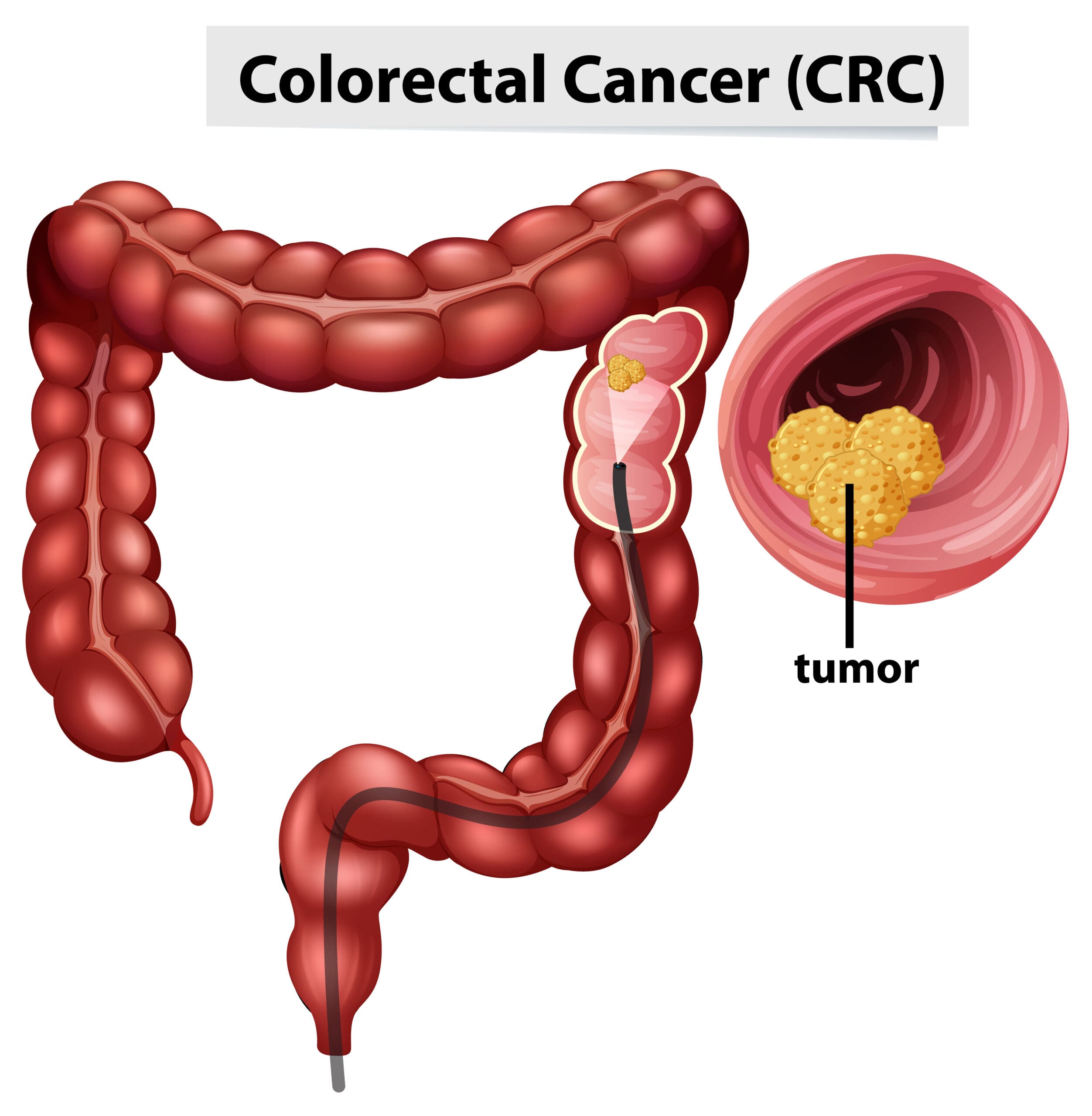 Câncer Colorretal: Sintomas, Tratamentos e Diagnóstico